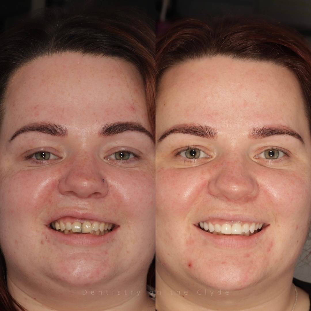 Dentistry On The Clyde | Smile Gallery Before and after treatment