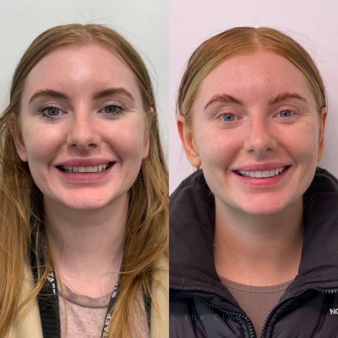 Dentistry On The Clyde | Smile Gallery Before and after treatment