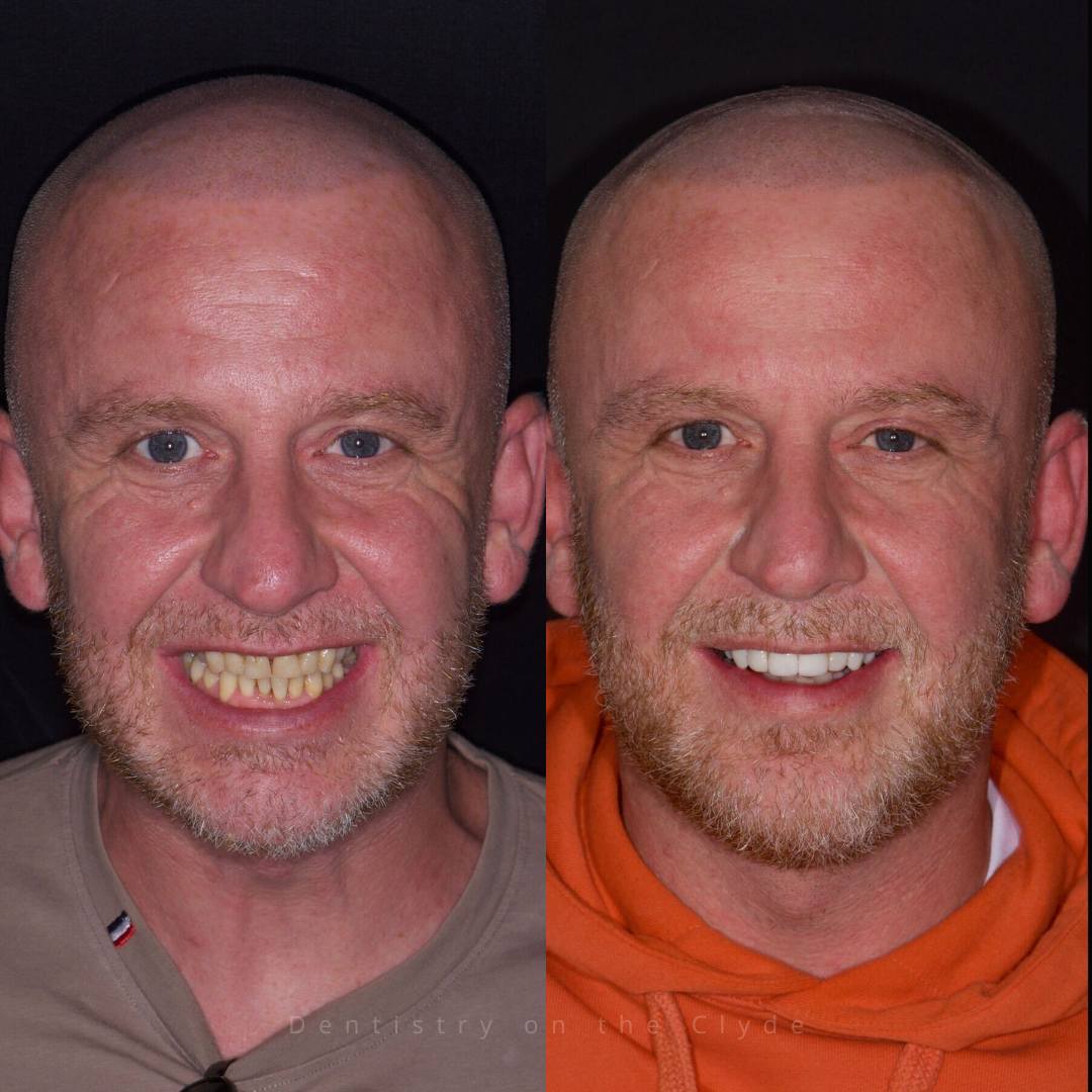 Dentistry On The Clyde | Smile Gallery Before and after treatment