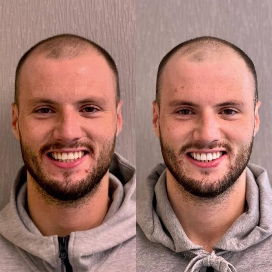 Dentistry On The Clyde | Smile Gallery Before and after treatment