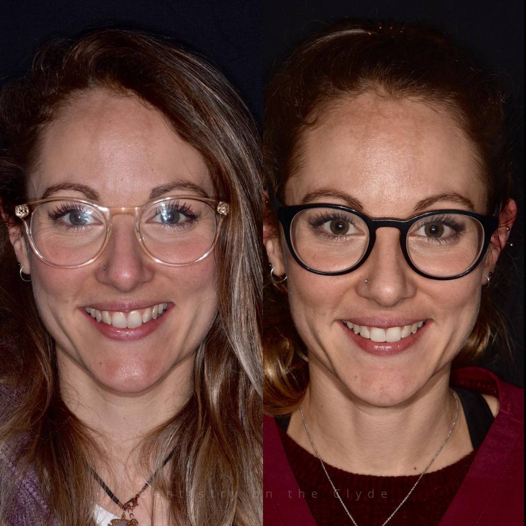 Dentistry On The Clyde | Smile Gallery Before and after treatment
