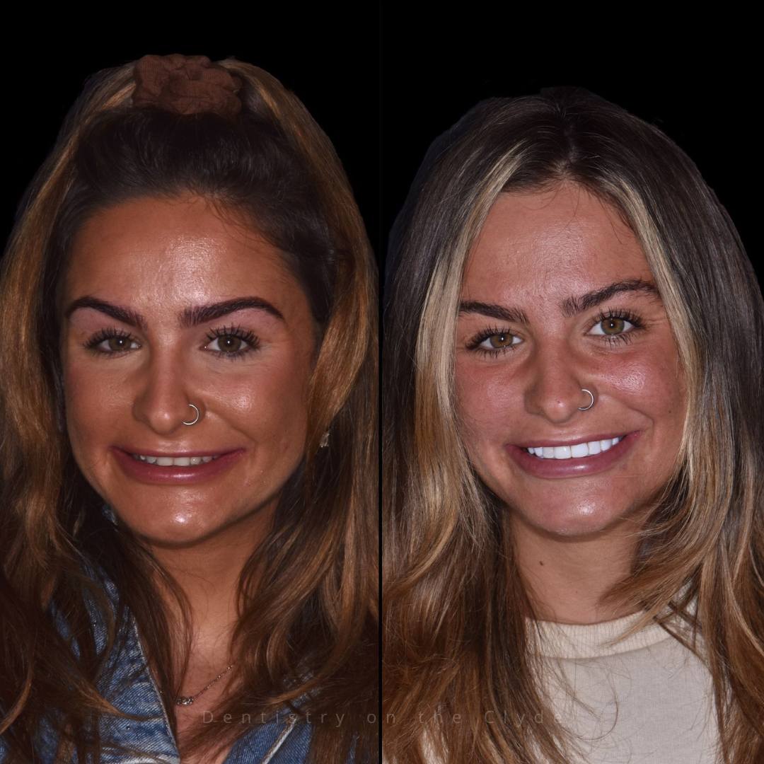 Dentistry On The Clyde | Smile Gallery Before and after treatment