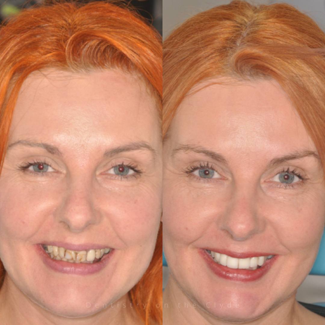 Dentistry On The Clyde | Smile Gallery Before and after treatment