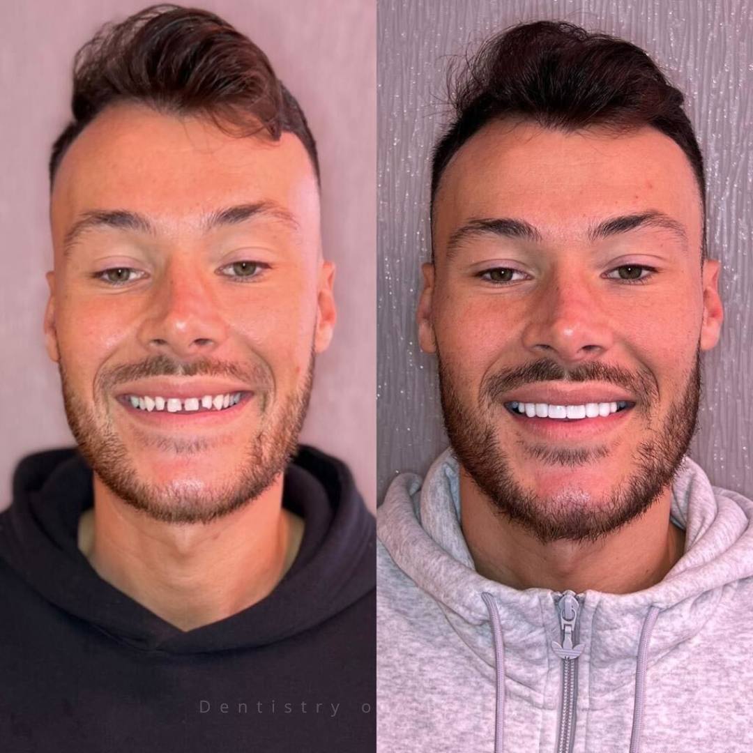 Dentistry On The Clyde | Smile Gallery Before and after treatment