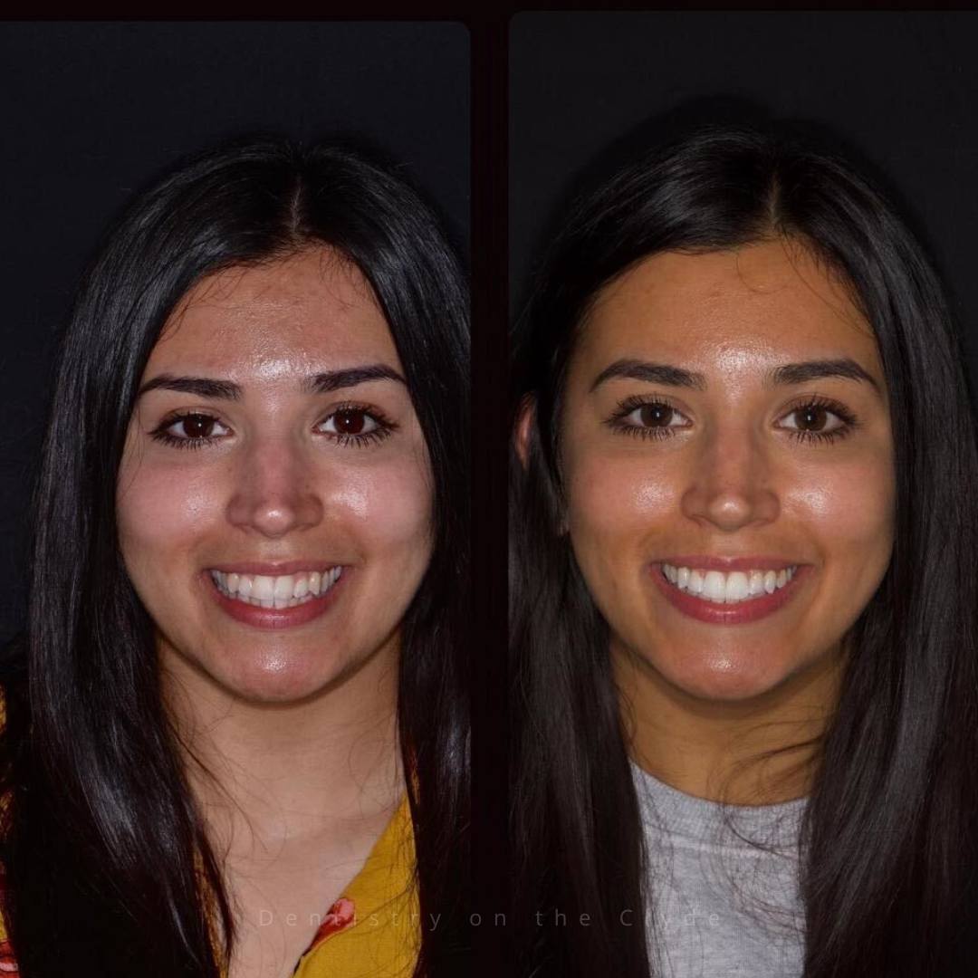 Dentistry On The Clyde | Smile Gallery Before and after treatment
