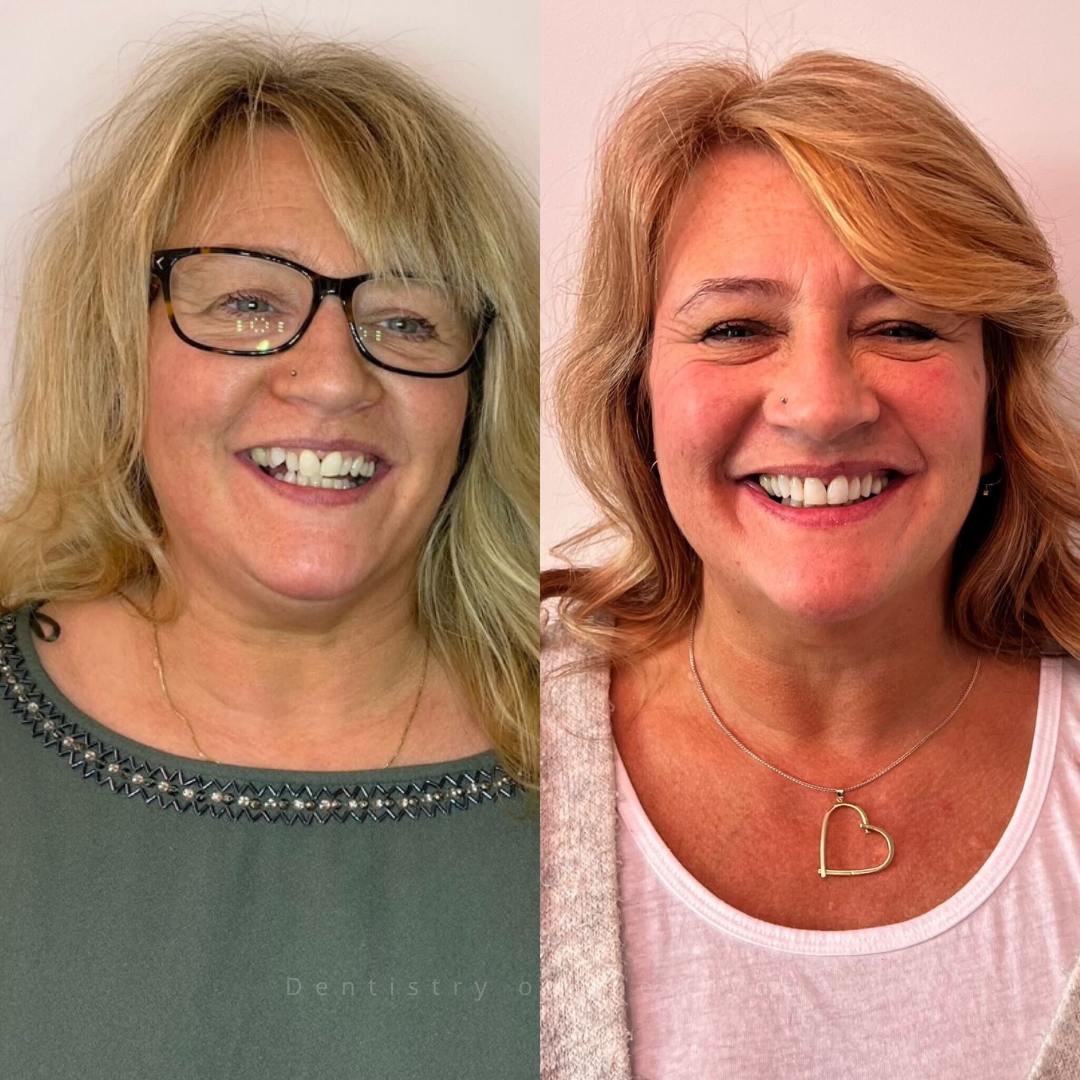 Dentistry On The Clyde | Smile Gallery Before and after treatment