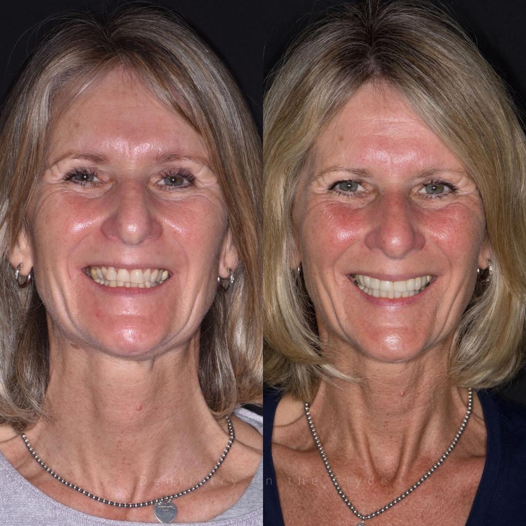 Dentistry On The Clyde | Smile Gallery Before and after treatment