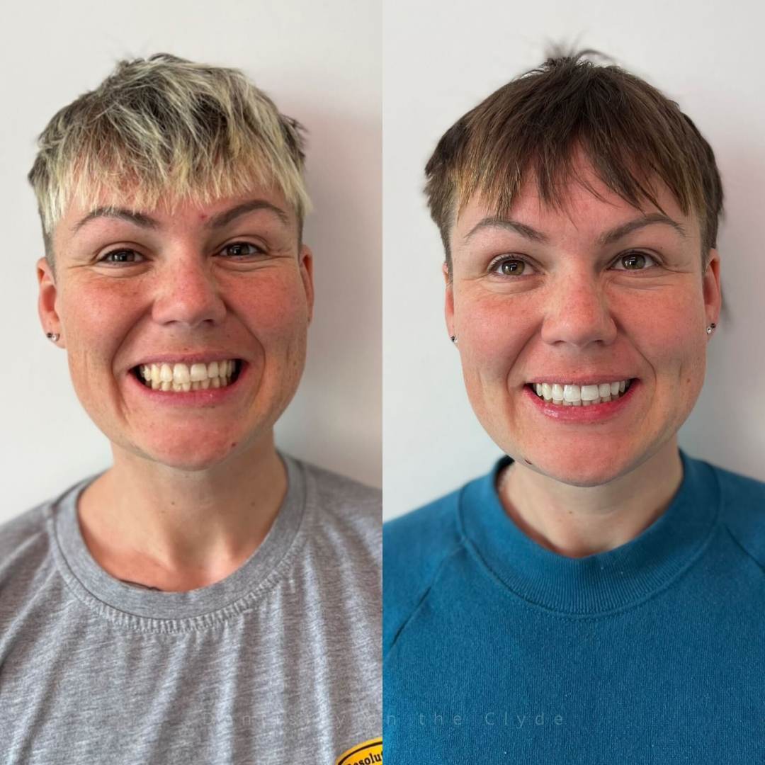 Dentistry On The Clyde | Smile Gallery Before and after treatment