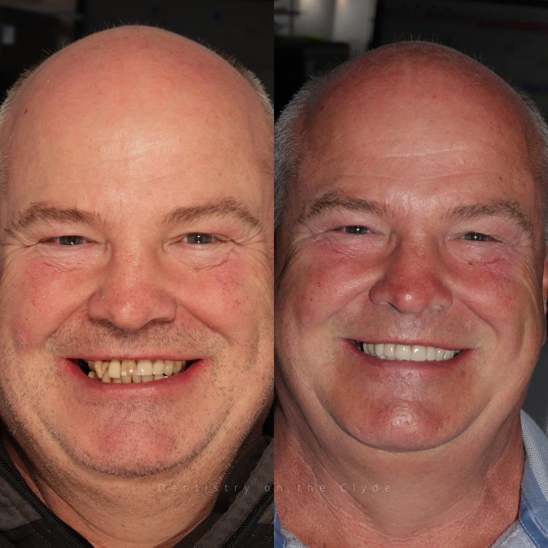 Dentistry On The Clyde | Smile Gallery Before and after treatment