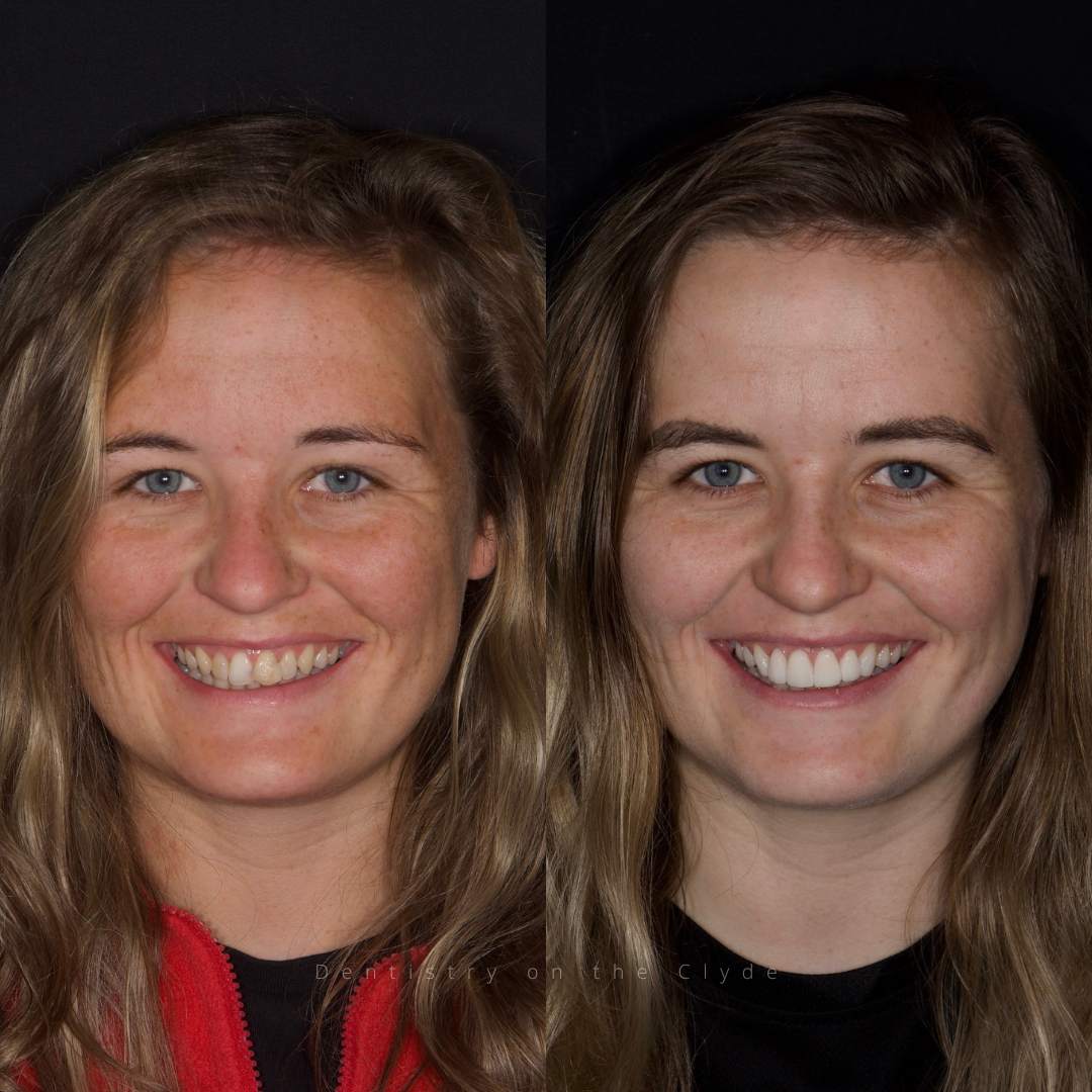 Dentistry On The Clyde | Smile Gallery Before and after treatment