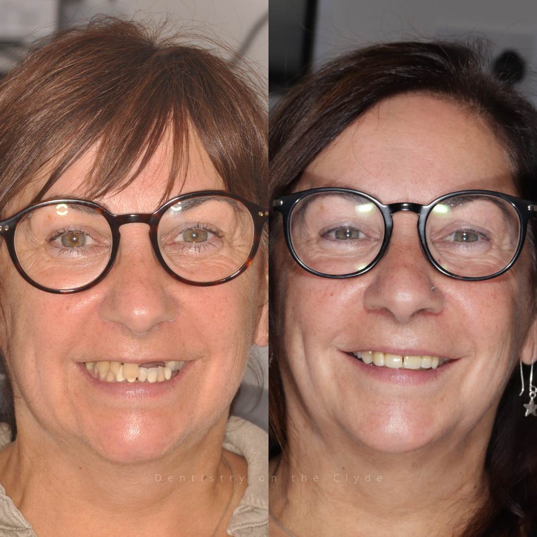Dentistry On The Clyde | Smile Gallery Before and after treatment