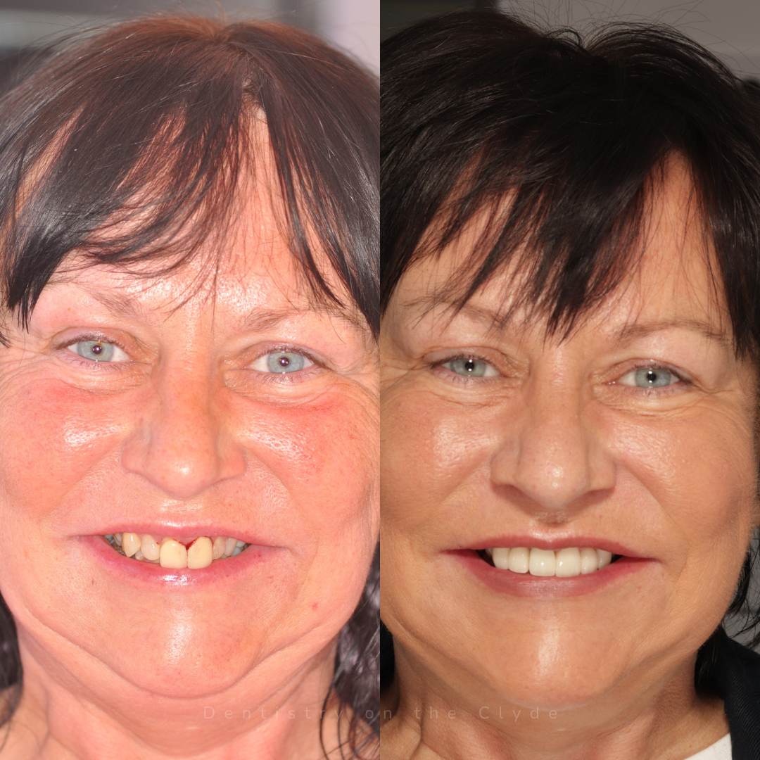 Dentistry On The Clyde | Smile Gallery Before and after treatment