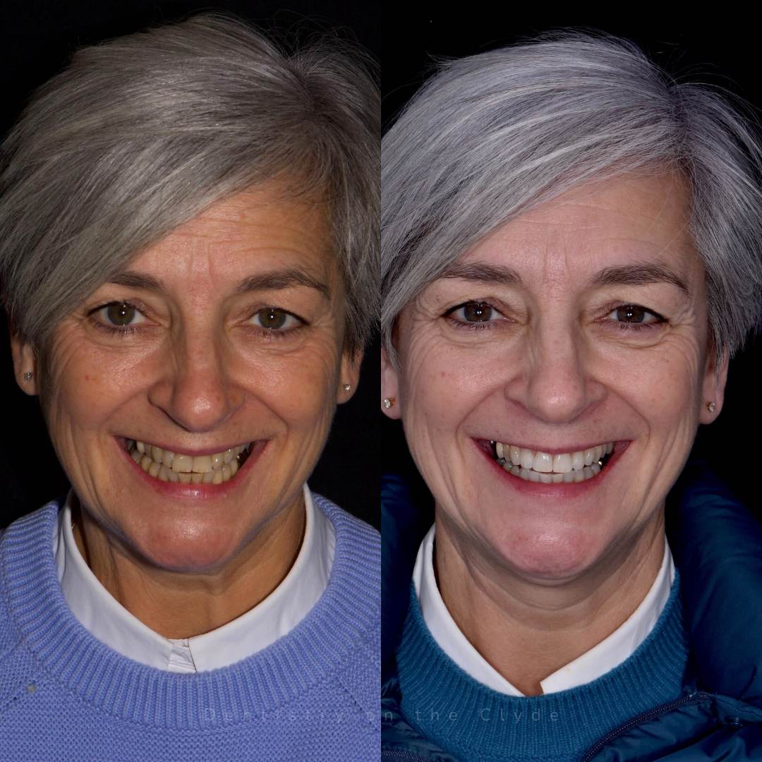 Dentistry On The Clyde | Smile Gallery Before and after treatment