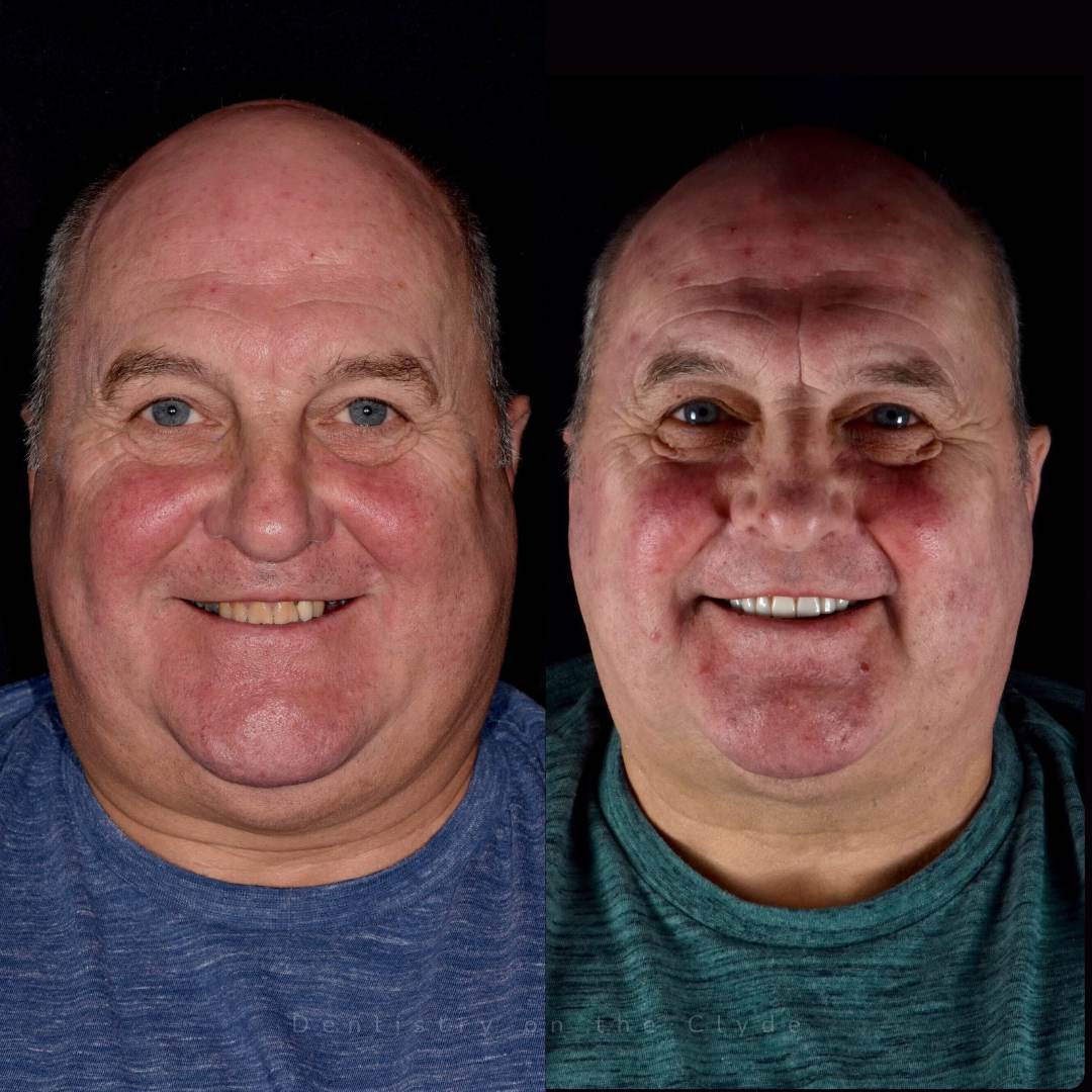 Dentistry On The Clyde | Smile Gallery Before and after treatment