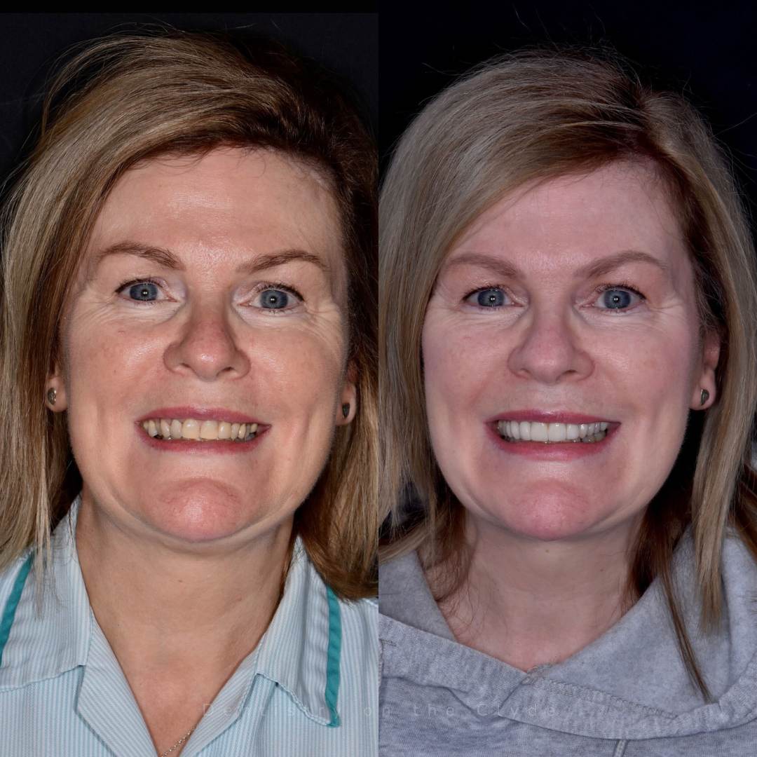 Dentistry On The Clyde | Smile Gallery Before and after treatment