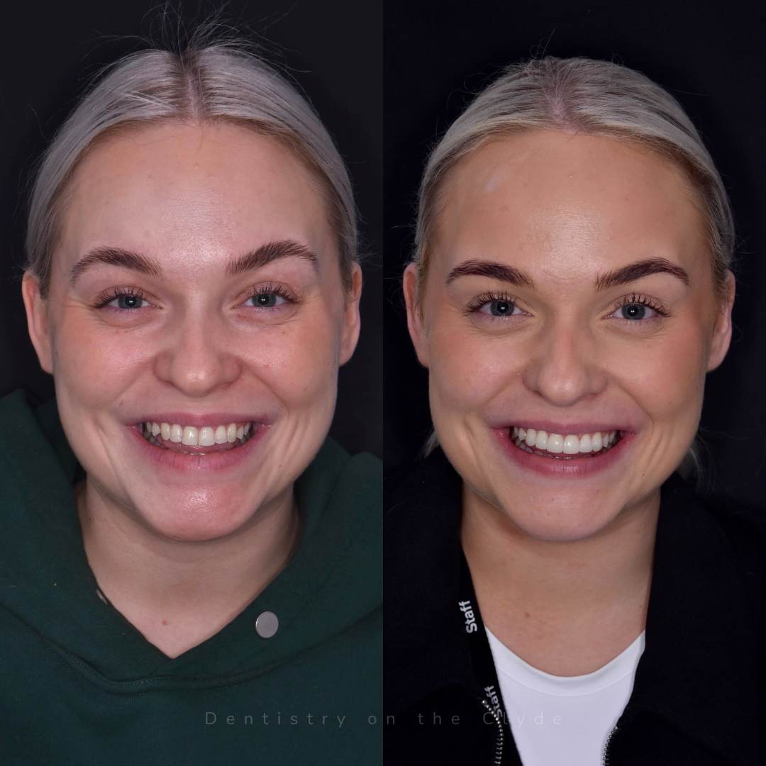 Dentistry On The Clyde | Smile Gallery Before and after treatment