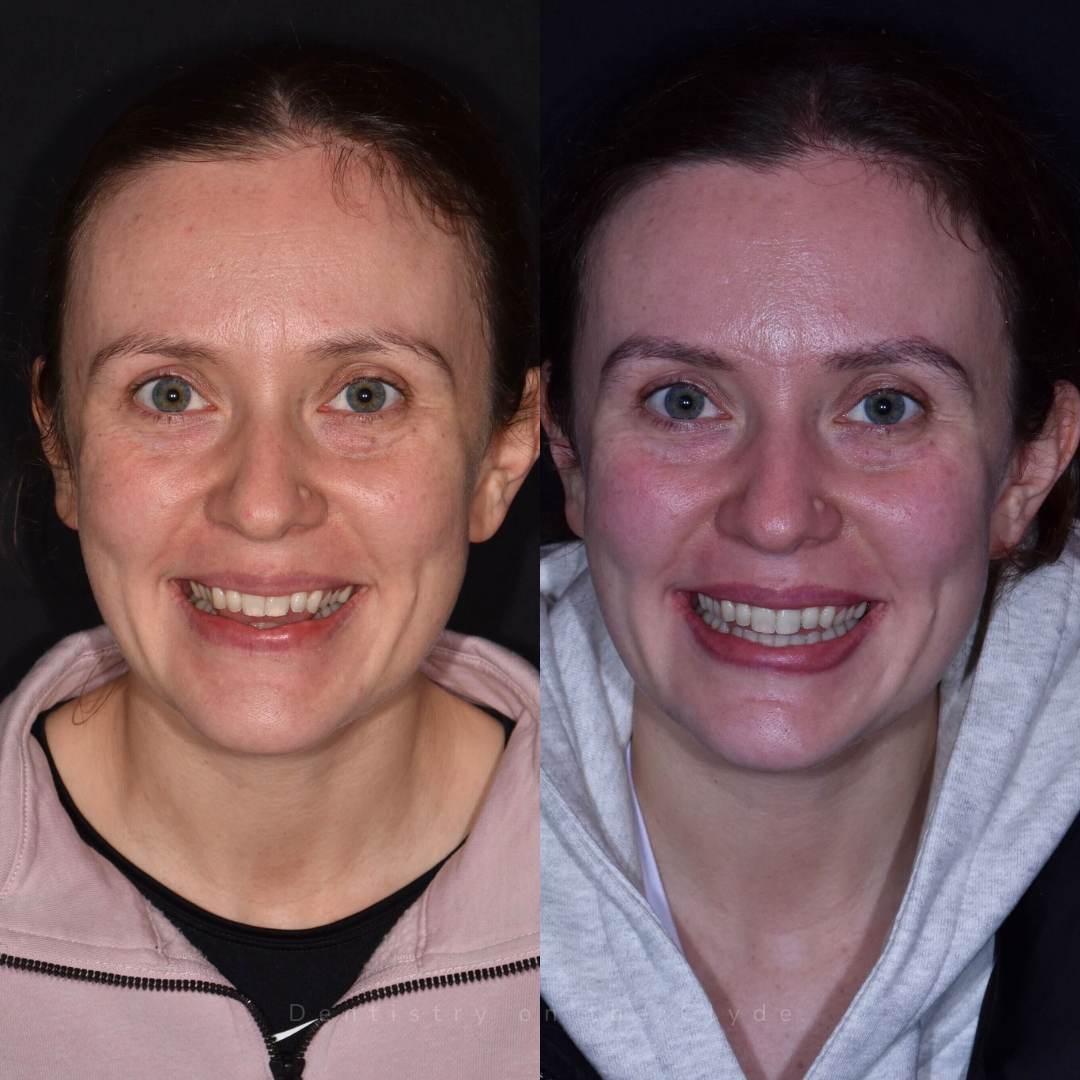 Dentistry On The Clyde | Smile Gallery Before and after treatment