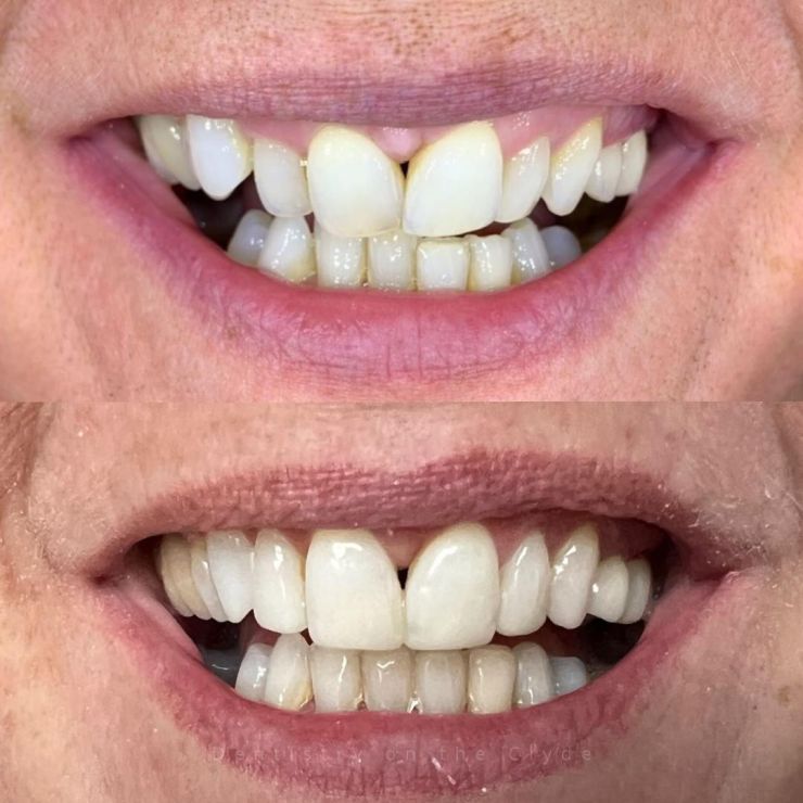 Dentistry On The Clyde | Smile Gallery Dentistry On The Clyde | Smile Gallery