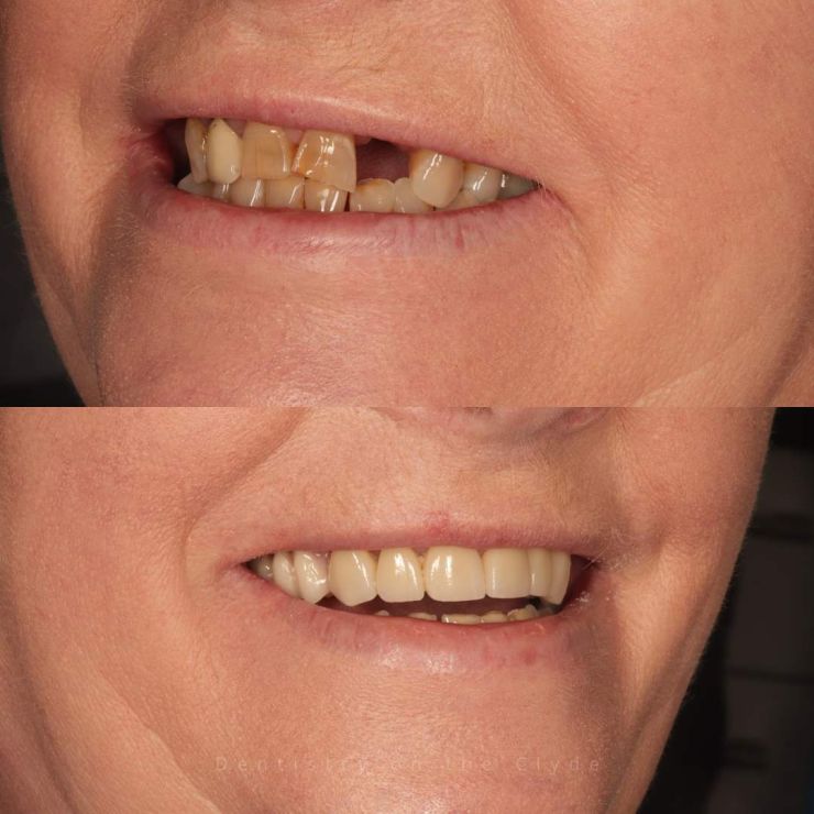 Dentistry On The Clyde | Smile Gallery Transforming Smiles
